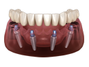Full Mouth Dental Implant Solutions
