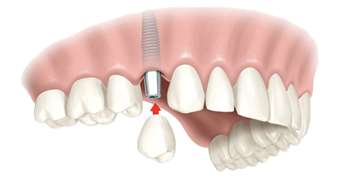 Single Dental Implants Braintree, MA