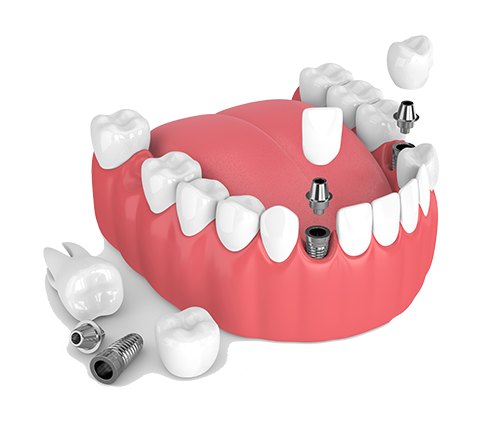 Multiple Teeth Dental Implants in Braintree, MA